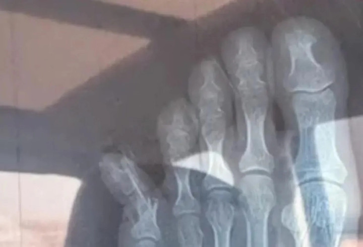 Ảnh chụp X-quang của Trương. (Ảnh: Baidu)