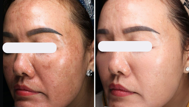 Hiệu quả của Mezopro trong trẻ hóa - xóa nám.