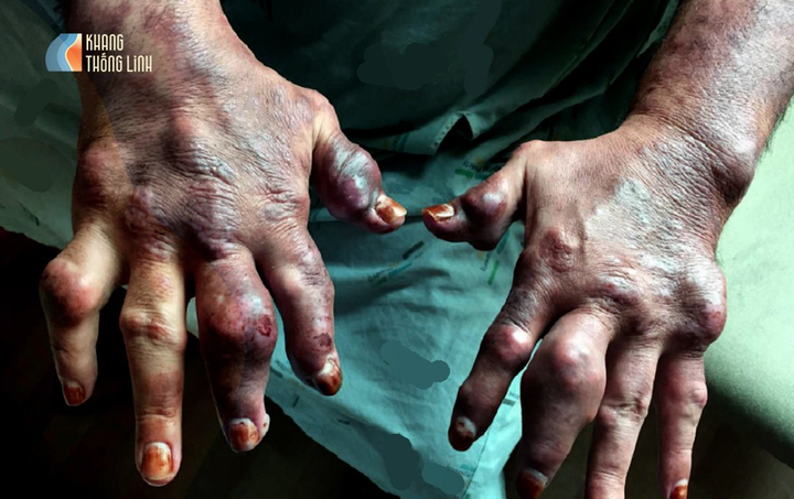 Khang Thống Linh - Viên uống hỗ trợ giảm sưng đau khớp, giảm acid uric máu - 2