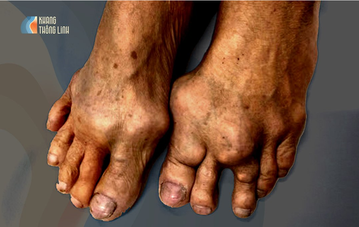 Khang Thống Linh - Viên uống hỗ trợ giảm sưng đau khớp, giảm acid uric máu - 3