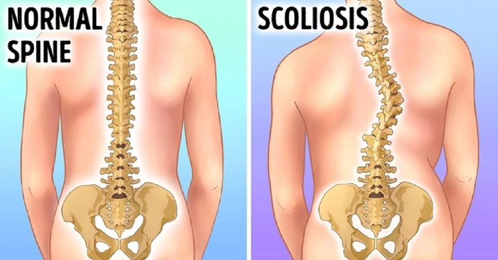 Một số môn thể thao có thể ảnh hưởng đến cột sống của trẻ.