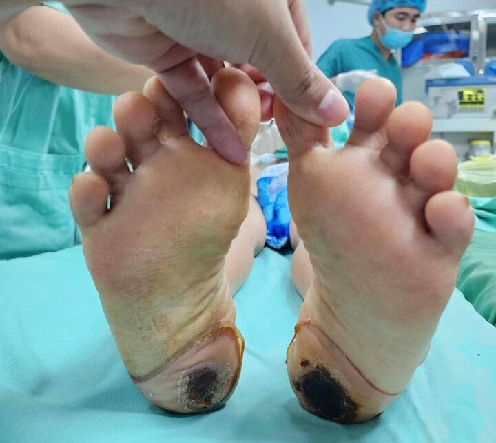 Bệnh nhân bị loét bỏng gan bàn chân 2 bên do dùng lá nam. (Ảnh: BVCC)