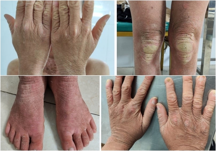 Tổn thương dày sừng nhiều, 1 số vảy tiết tập trung thành mảng lớn vùng cẳng chân 2 bên.