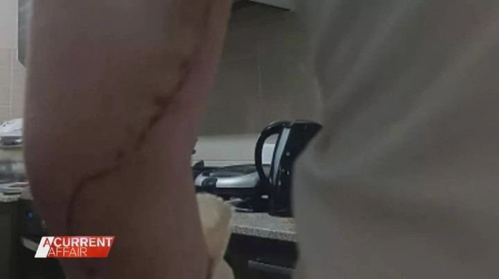 Cánh tay của Love bị tổn thương nghiêm trọng. (Ảnh: Nine News)