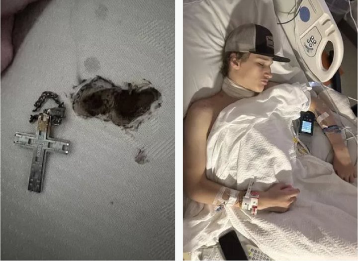 Sợ dây chuyền thánh giá khiến chàng trai 16 tuổi bỏng nặng. (Ảnh: Kennedy News)