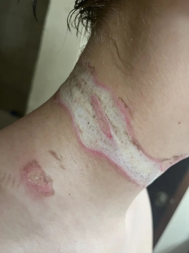 Vùng da quanh cổ của chàng trai bị lở loét. (Ảnh: Kennedy News)