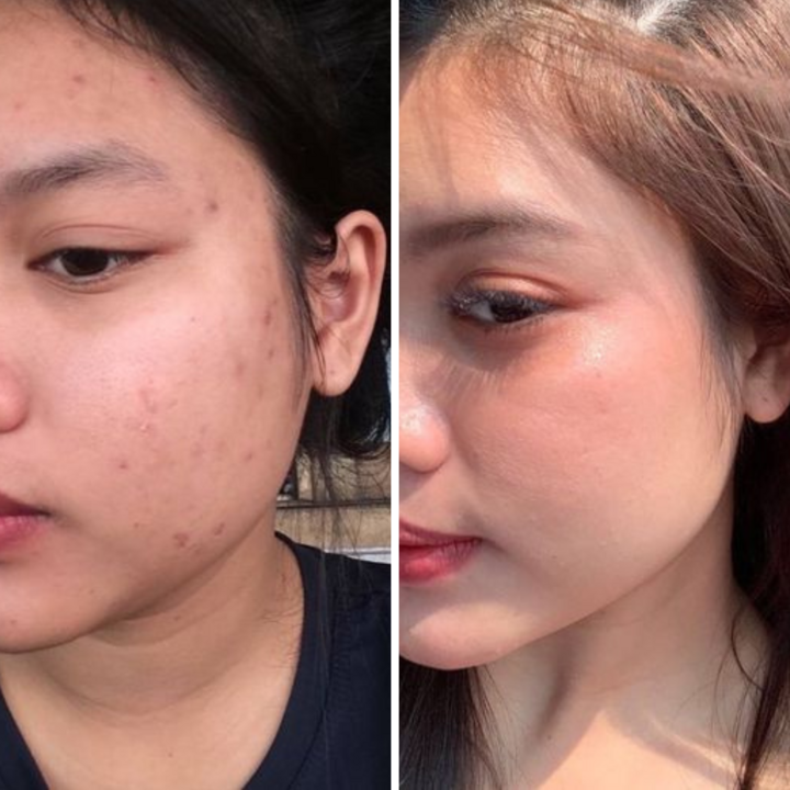 Hình ảnh sau khi khách hàng sử dụng bộ đôi Serum và Kem Coome.