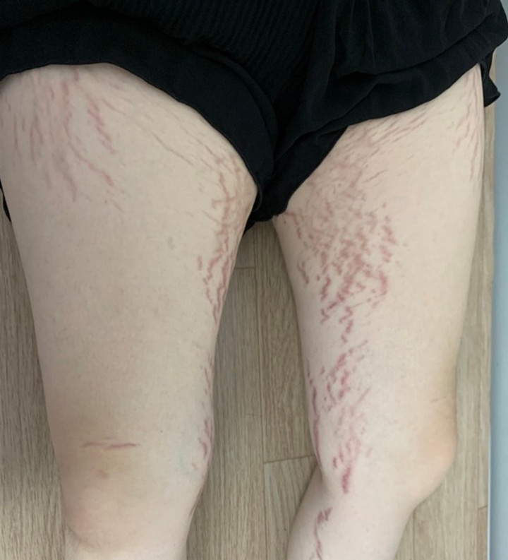 Chân cô gái xuất hiện vết rạn đỏ sau khi dùng thuốc.