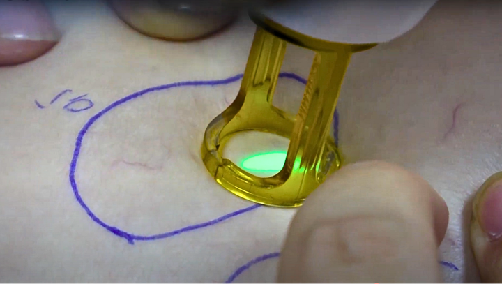 Laser xung dài khuyên dùng để điều trị tĩnh mạch mạng nhện - Nguồn: Dr.Vein