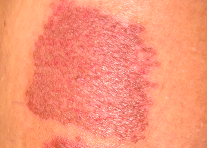 Biến chứng tấy đỏ, nổi bóng nước sau khi bắn laser xung dài - Nguồn: mikemurphyblog