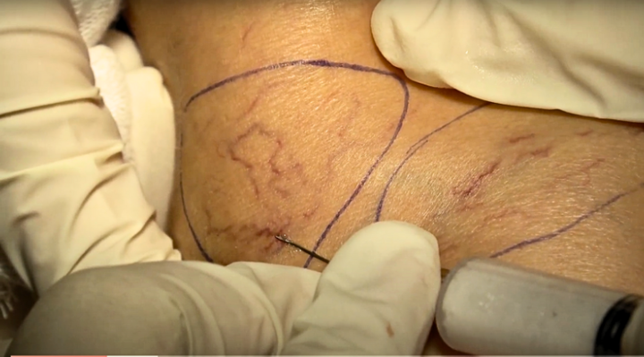 Tiêm xơ khuyên dùng cho giãn tĩnh mạch nông độ 1 dạng lưới - Nguồn: Dr.Vein