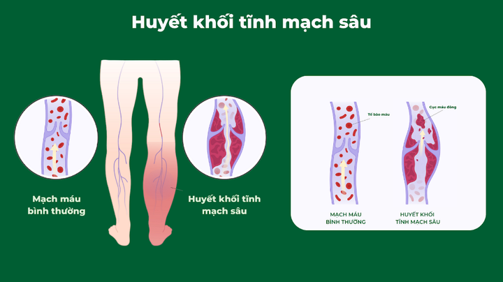 Minh hoạ huyết khối tĩnh mạch sâu. Nguồn Dr.Vein