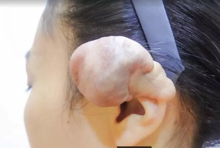 Một bệnh nhân với phần vành tai bị biến dạng do di chứng nhiễm trùng sau khi xỏ lỗ tai.
