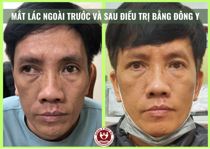 Giải thích hiện tượng 'Mắt lác ngoài' - 2