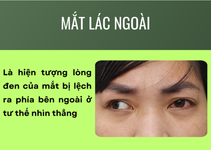 Giải thích hiện tượng 'Mắt lác ngoài' - 1