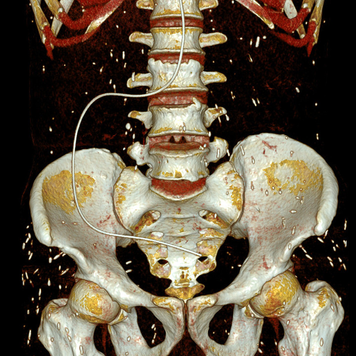 Hình ảnh chụp cho thấy sán ký sinh khắp cơ thể bệnh nhân.