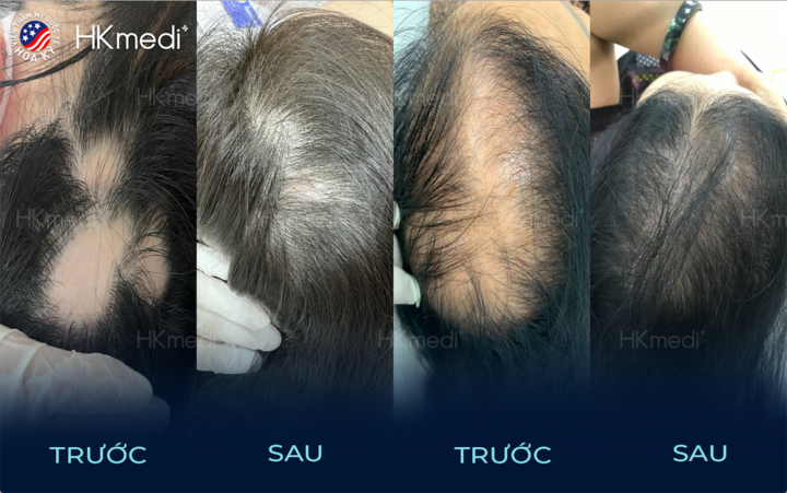 Hiệu quả mà công nghệ Tái sinh mầm tóc Mesotide đem lại.
