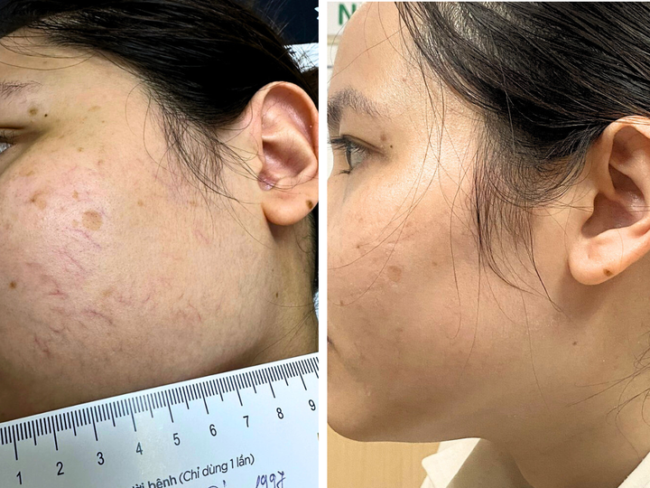 Kết quả sau khi điều trị bằng Dual Cool Laser. (Ảnh: Dr.Vein)