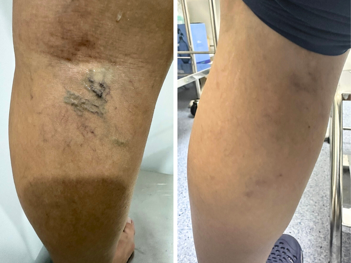 Kết quả sau khi điều trị bằng Sclaser. (Ảnh: Dr.Vein)