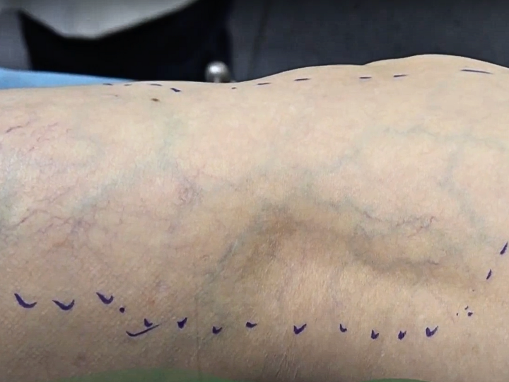 Sclaser điều trị tối ưu giãn tĩnh mạch xuất hiện đồng thời dạng lưới và mạng nhện. (Ảnh: Dr.Vein)