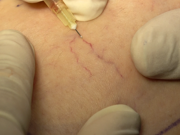 Tiêm xơ điều trị giãn tĩnh mạch lưới. (Ảnh: Dr.Vein)