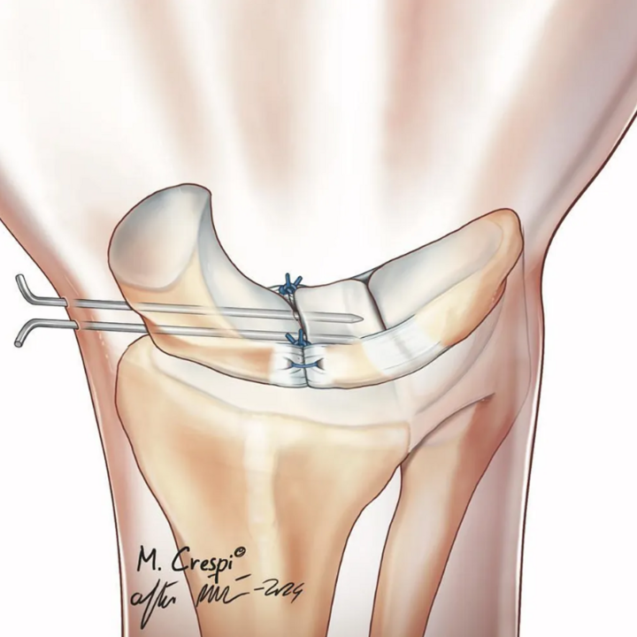 Các bác sĩ cố định khớp cổ tay của Unai Simon.