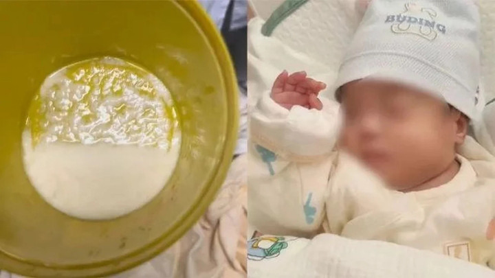 Em bé đáng thương có lượng sữa đáng kể trong phổi. (Ảnh: Weibo)