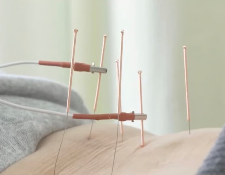 Châm cứu là phương pháp đã có từ lâu đời của y học cổ truyền Trung Quốc. (Ảnh: Weibo)