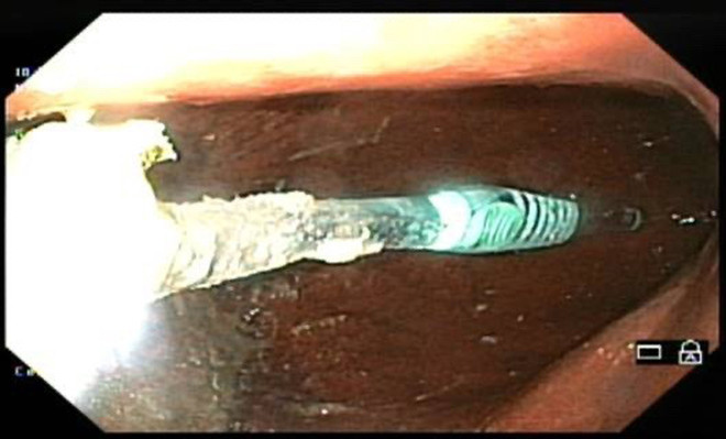 Hình ảnh gắp dị vật là bàn chải đánh răng trong dạ dày của bệnh nhân tại Bệnh viện trường Đại Học Kỹ thuật Y tế Hải Dương.