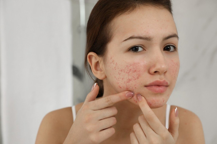 Không ít chị em có thể gặp phản ứng dị ứng với một số thành phần có trong các loại mỹ phẩm.