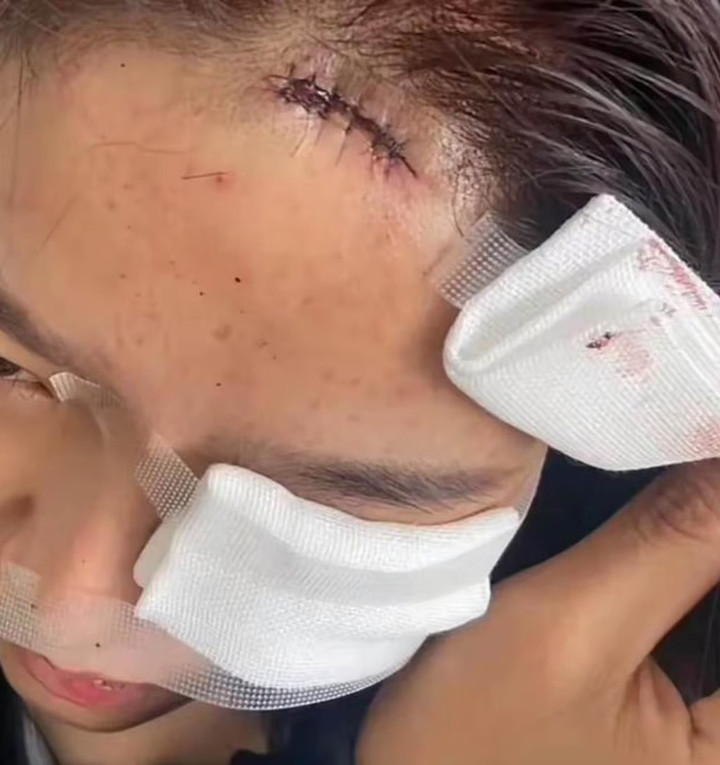 Người chồng bị khâu khoảng 20 mũi ở mặt, còn vợ phải khâu 17 mũi ở trán. (Ảnh: 163.com)