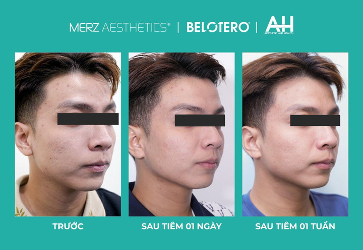 Làn da căng bóng, sáng mịn hơn hẳn của khách hàng sau khi tiêm Belotero Revive. (Ảnh: Aesthetic And Health)