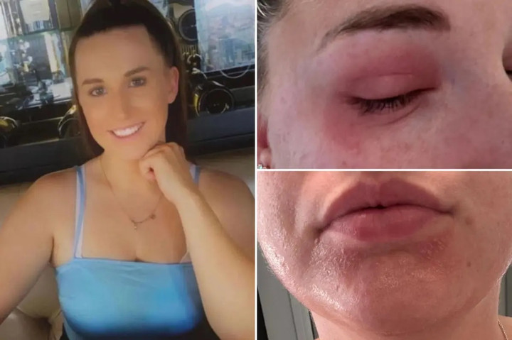 Người phụ nữ mắc bệnh hiếm gặp, bị dị ứng với chính kỳ kinh nguyệt của mình. (Ảnh: NYP)