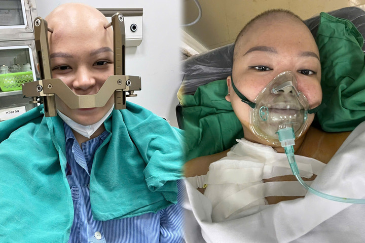 Chị Thu trải qua 77 lần truyền hóa chất, 2 lần xạ phẫu khối u não bằng gamma knife, 20 mũi xạ trị khối u vú. (Ảnh: GĐCC)