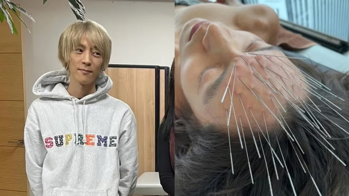 Những chiếc kim gần như phủ kín trán trông đáng sợ đến mức bị Instagram gắn cờ đánh dấu "nội dung nhạy cảm". (Ảnh: Weixin)