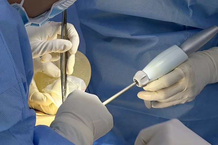 Tiến bộ mới trong nâng ngực thẩm mỹ: Công nghệ dao siêu âm Harmo-5K - 3