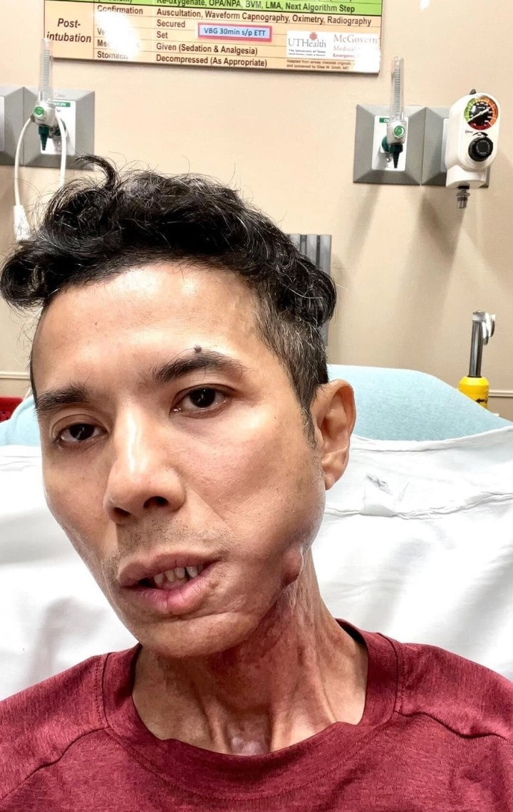 Kasim Hoàng Vũ sẽ phẫu thuật cấy ghép xương hàm.