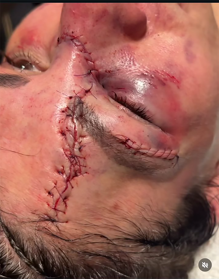 Irene Aldana phải khâu nhiều mũi sau trận đấu