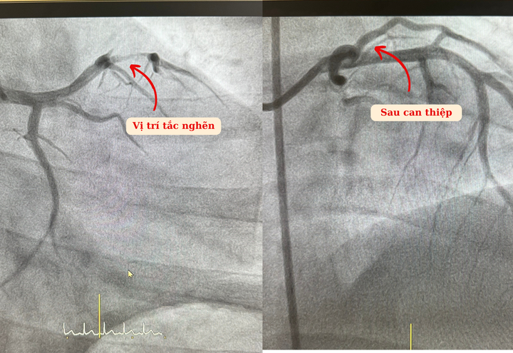 Hình ảnh kết quả trước và sau can thiệp của anh Tình.
