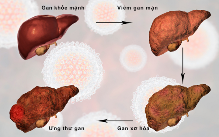 Heposal - Giải pháp hỗ trợ phục hồi chức năng gan và giảm xơ hóa hiệu quả - 1