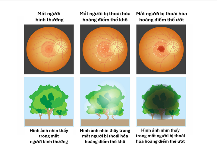 Nhìn thấy đường thẳng bị cong méo và màu sắc, độ sáng bị giảm cường độ là những biểu hiện đặc trưng ban đầu của bệnh thoái hóa hoàng điểm tuổi già.