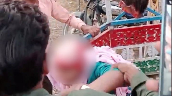 Da đầu của nữ sinh bị xé toạc khi tóc bị kẹt trong vòng đu quay trong trò chơi. (Ảnh: TIM)