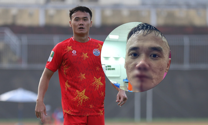 Xuân Nam bị thương.