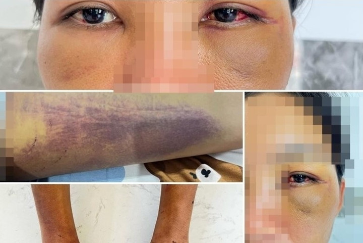 Những vết thương trên người chị Dung lúc thoát khỏi "địa ngục" (Ảnh: CACC)