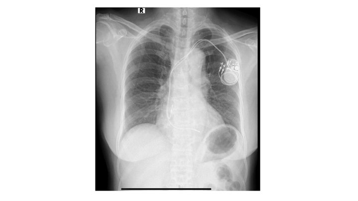 Hình ảnh một ca điều trị rối loạn nhịp tim hiệu quả bằng giải pháp ít xâm lấn cho bệnh nhân nữ 75 tuổi. (Ảnh: Thuỳ Dương)