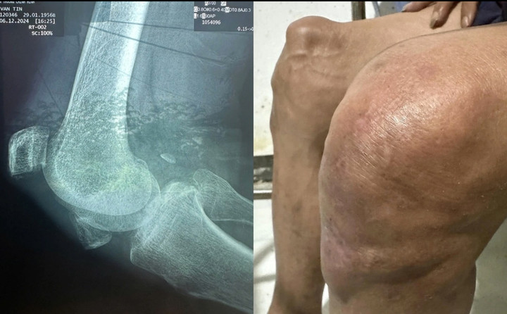 Thương Tín bị viêm khớp gối nặng.