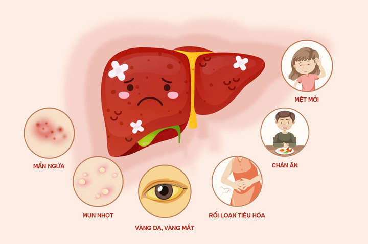 Suy giảm chức năng gan gây nhiều hệ lụy cho sức khỏe.