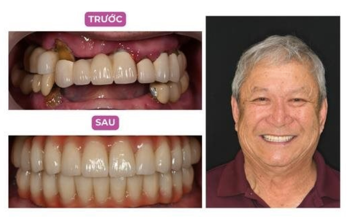 Chú Hiệp (70 tuổi) - Việt Kiều Canada, rất hài lòng sau khi hoàn thành ca phục hình toàn hàm bằng kỹ thuật Implant All-on-4. Chú chia sẻ: “Lúc đến Elite, chú cảm thấy rất yên tâm khi nghe bác sĩ Lâm tư vấn về implant và quyết định thực hiện ngay. Tay nghề của bác sĩ rất giỏi, phòng khám đầy đủ trang thiết bị hiện đại. Chú đã nhổ hết hai hàm răng và trồng trụ Implant mà không hề bị đau, sưng hay bầm tím gì cả.”