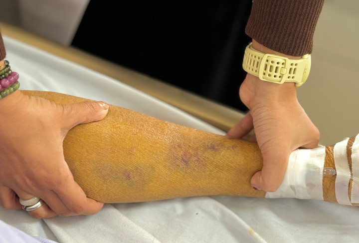 Dấu hiệu vàng da ở người bệnh rất rõ rệt. (Ảnh: Thanh Đặng)