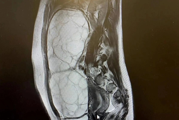 Alex được thông báo rằng cô ấy bị u tuyến yên tiết hormone kích thích nang trứng hiếm gặp. (Ảnh: The Mirror)